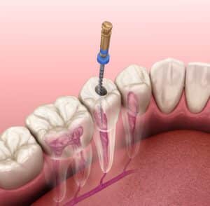 root canal therapy paso robles dental dentist in paso robles, ca