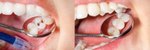 composite fillings paso robles dental dentist in paso robles, ca