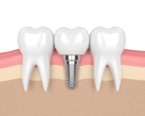 dental implants paso robles dental dentist in paso robles, ca