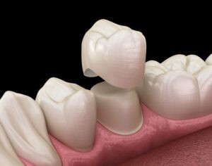dental crowns paso robles dental dentist in paso robles, ca