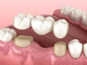 dental bridges paso robles dental dentist in paso robles, ca