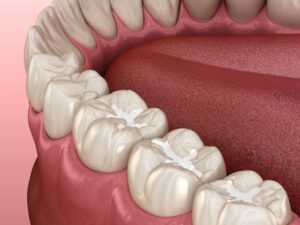 sealants paso robles dental dentist in paso robles, ca