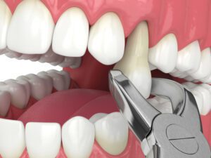 tooth extractions paso robles dental dentist in paso robles, ca
