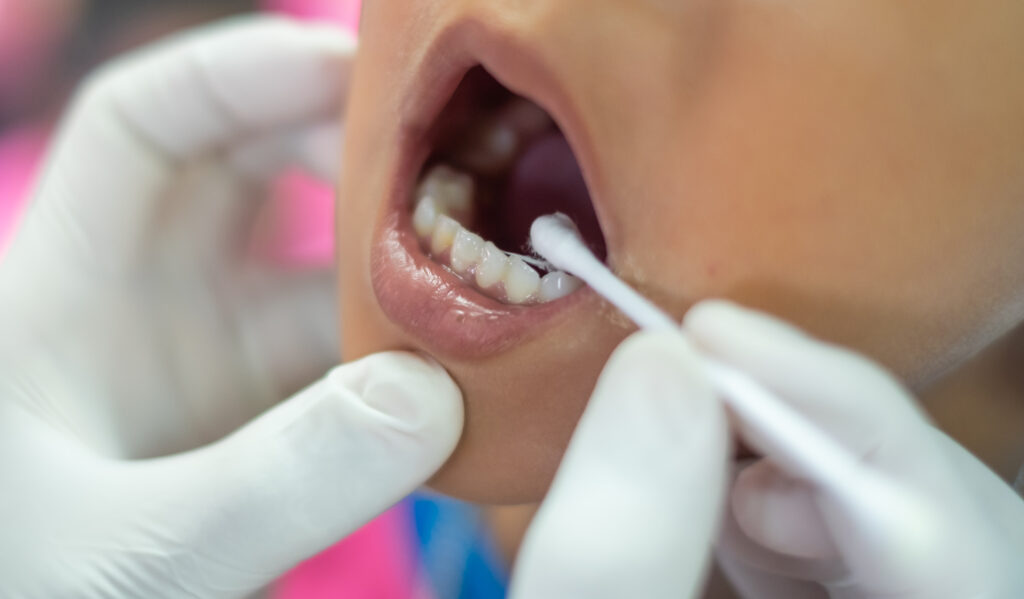 fluoride treatment paso robles