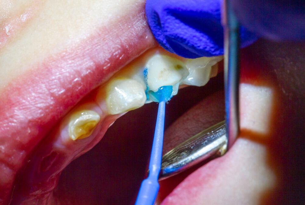 dental sealants paso robles